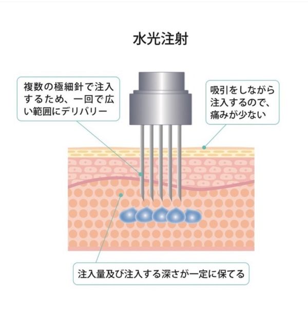 水光注射説明イラスト